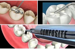 Địa Chỉ Trám Răng Bình Thạnh uy tín