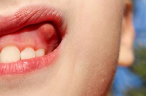Ép xe răng hình thành do nhiều nguyên nhân khác nhau