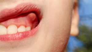 Ép xe răng hình thành do nhiều nguyên nhân khác nhau