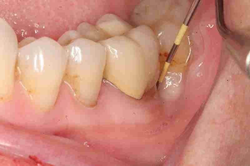 Nha sĩ sẽ sử dụng phương pháp dẫn lưu áp xe, điều trị tủy hay nhổ bỏ răng tùy thuộc vào mức độ bệnh.