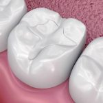 Bọc răng composite