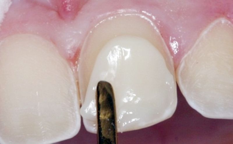Bọc răng composite có nhiều ưu điểm nổi bật
