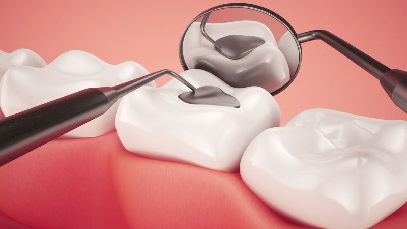 Những lưu ý cần thiết khi bọc răng composite