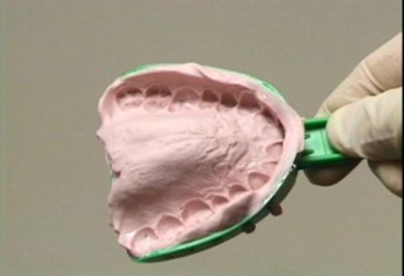 Lấy dấu răng để chế tác ra mẫu răng sứ vừa vặn với răng thật.