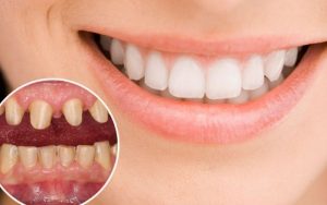 Bọc răng sứ giúp khắc phục đa số các khuyết điểm nhẹ đến vừa phải của hàm răng tự nhiên