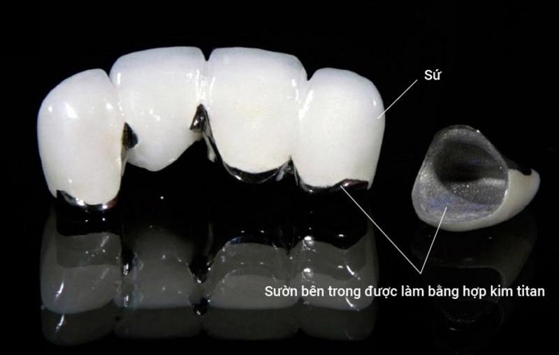 Bọc răng sứ titan là phương pháp phổ biến giúp khắc phục các tổn thương răng miệng dạng nhẹ
