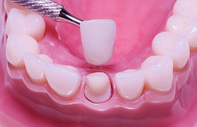 Bọc răng sứ là phương pháp phục hình thẩm mỹ cho răng, giúp khắc phục triệt để các nhược điểm của răng