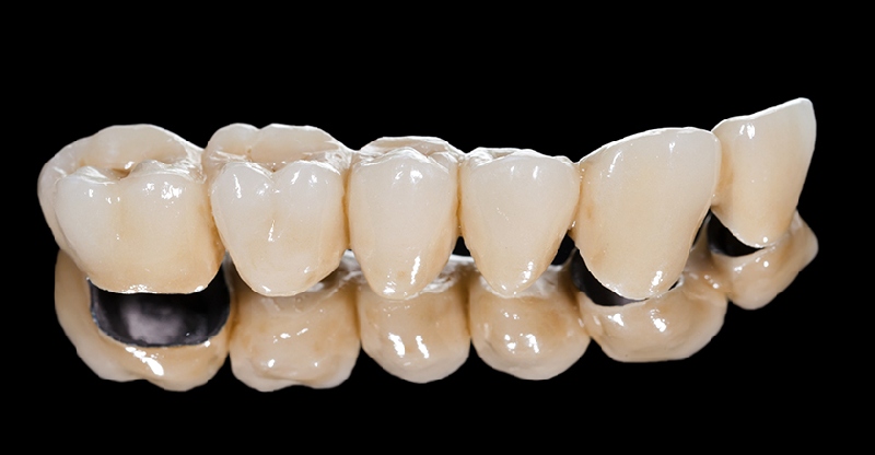 Răng sứ kim loại thường được cấu tạo gồm phần kim loại ở bên trong và phần sứ phủ bên ngoài