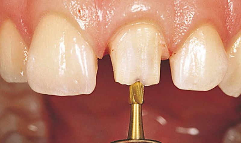 Quy trình bọc răng vàng tại nha khoa