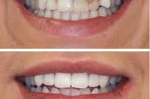 Tìm hiểu quy trình bọc răng sứ cho răng khểnh