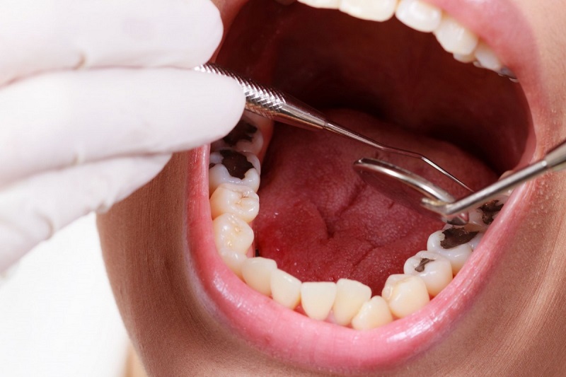 Để xác định nguyên nhân gây đau buốt ở răng bạn nên đến gặp nha sĩ