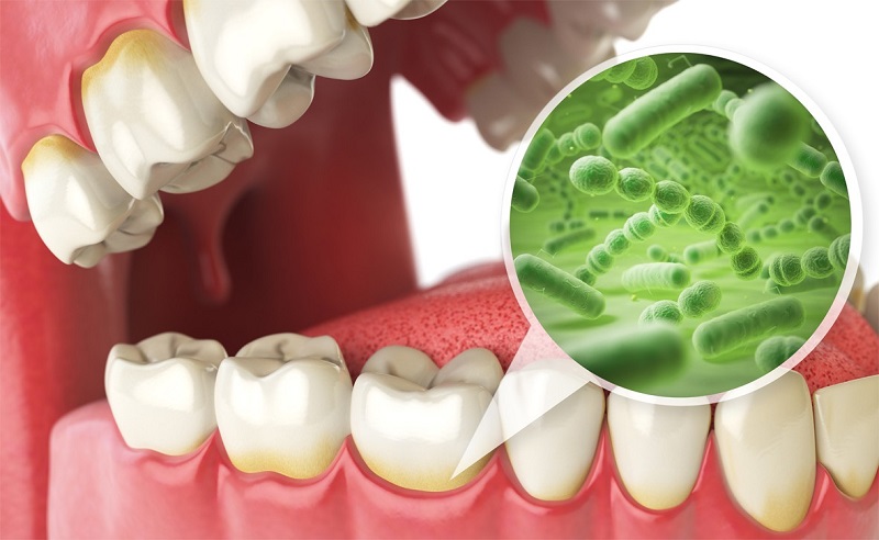 Để lâu cao răng có thể trở thành nguyên nhân hàng đầu gây ra các bệnh lý nha khoa nghiêm trọng