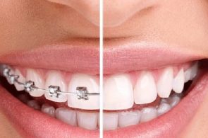 Nên niềng răng hay bọc răng sứ? Đâu là lựa chọn hoàn hảo?