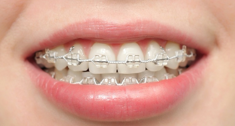 Niềng răng là phương pháp dịch chuyển răng bằng cách dùng các khí cụ nha khoa chuyên dụng