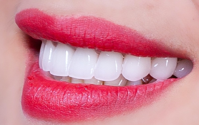 Răng sứ đóng vai trò như lớp màng chắn vững chắc bảo vệ cho răng thật