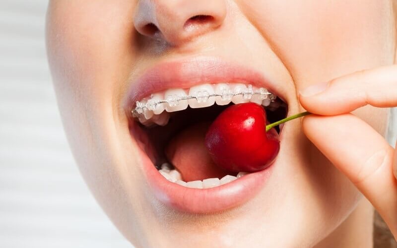 Ăn các loại thực phẩm mềm trong quá trình niềng răng
