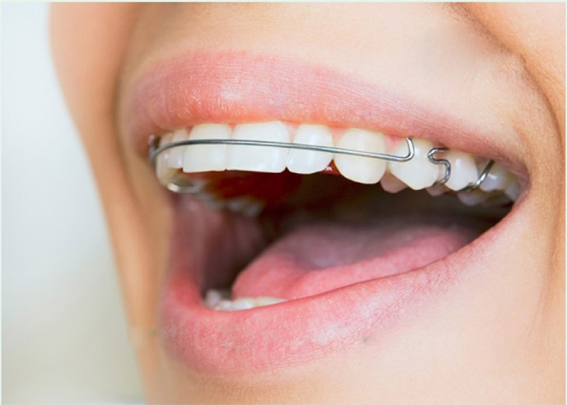 Niềng răng vẫn có thể khiến răng bị yếu đi trong một số trường hợp