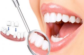 Quy trình bọc răng sứ chuẩn mang lại hàm răng đẹp như ý