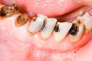Sâu răng là gì? Hình ảnh, nguyên nhân và cách chữa khỏi