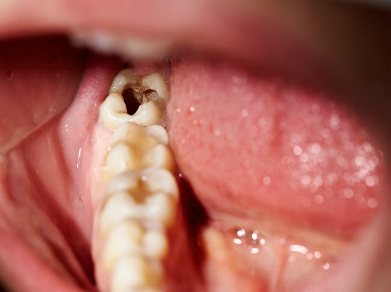 Bệnh liên quan nhiều đến thói quen vệ sinh răng miệng