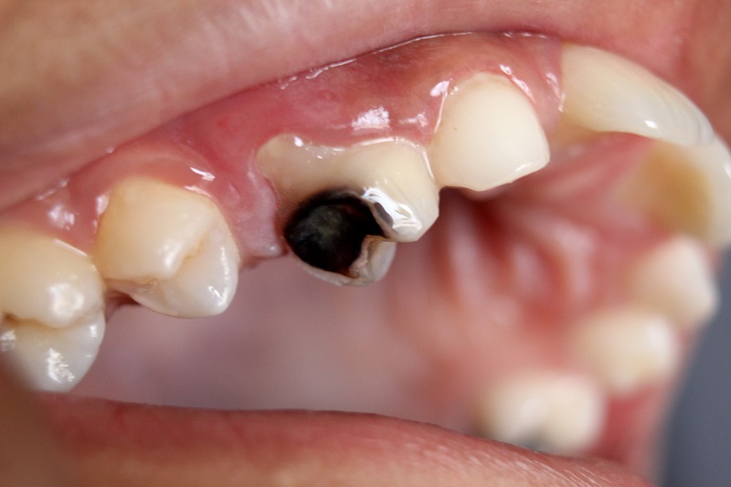 Răng sâu phát triển qua 4 giai đoạn với mức độ nặng - nhẹ khác nhau
