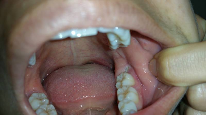 Bệnh nhân sâu răng nặng có thể được chỉ định nhổ răng