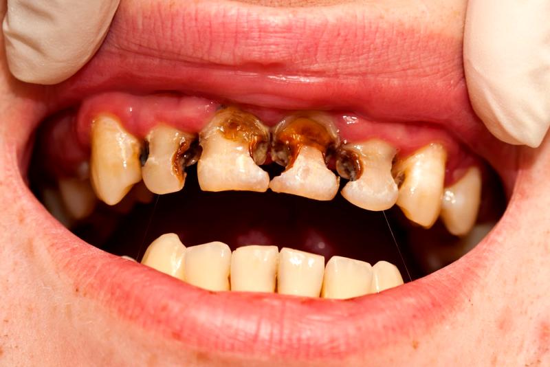 Răng bị sún sẽ ảnh hưởng đến khả năng phát âm ở trẻ