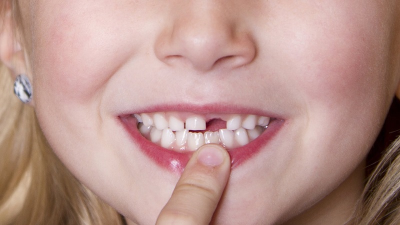 Quá trình mọc và thay răng sữa ở mỗi trẻ là khác nhau