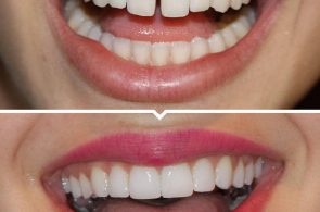 Một số trường hợp bọc răng sứ mang lại hiệu quả cao