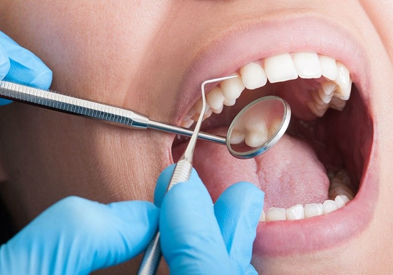 Bác sĩ sẽ tiến hành lấy vôi răng để loại bỏ yếu tố gây nên bệnh