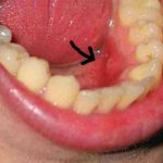 Làm thế nào để điều trị viêm chân răng có mủ dứt điểm?