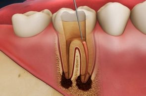 Bệnh viêm tủy răng: Nguyên nhân, dấu hiệu và biện pháp điều trị