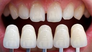 Việc hạn chế mài răng sẽ giúp răng chắc khỏe hơn