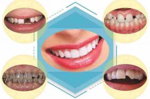 Bọc răng sứ giúp tăng tính thẩm mỹ cho hàm răng