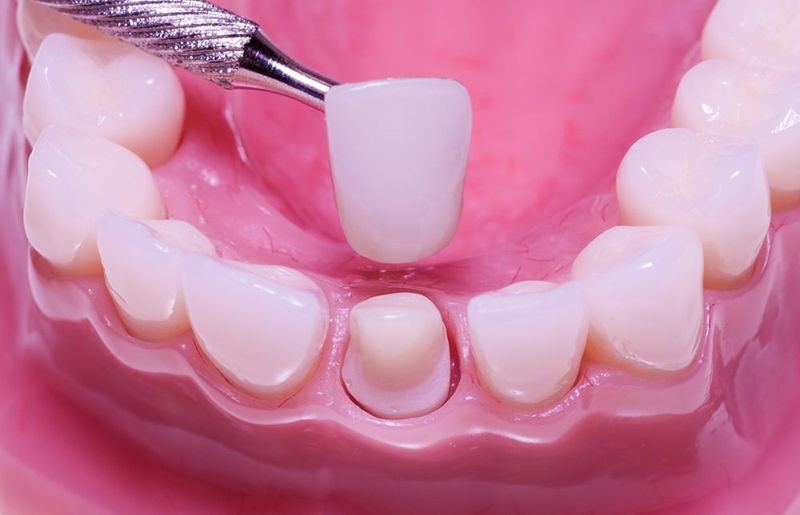 Khi tiến hành cần hạn chế xâm lấn và giữ lại tối đa răng gốc