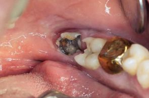 Sâu răng nguy hiểm hơn nhiều so với việc chỉ gây đau nhức