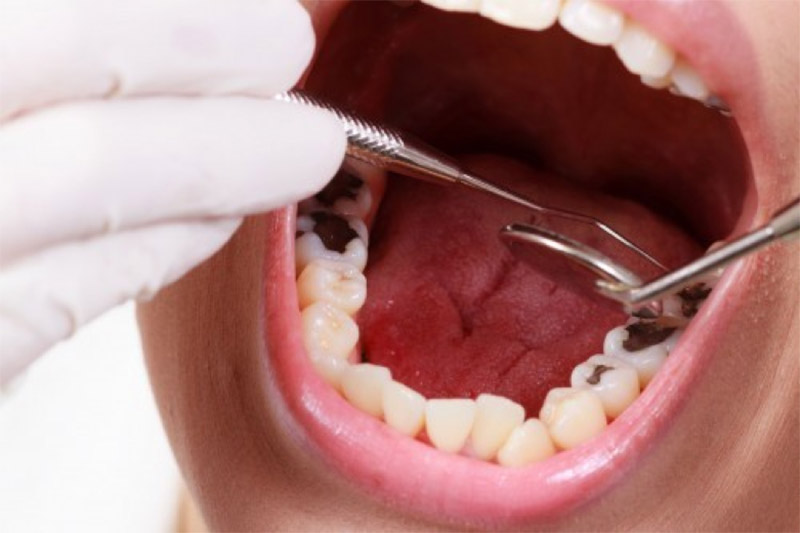 Bệnh lý sâu răng không thể chưa khỏi hoàn toàn mà chỉ mang tính ngăn chặn sự lây lan