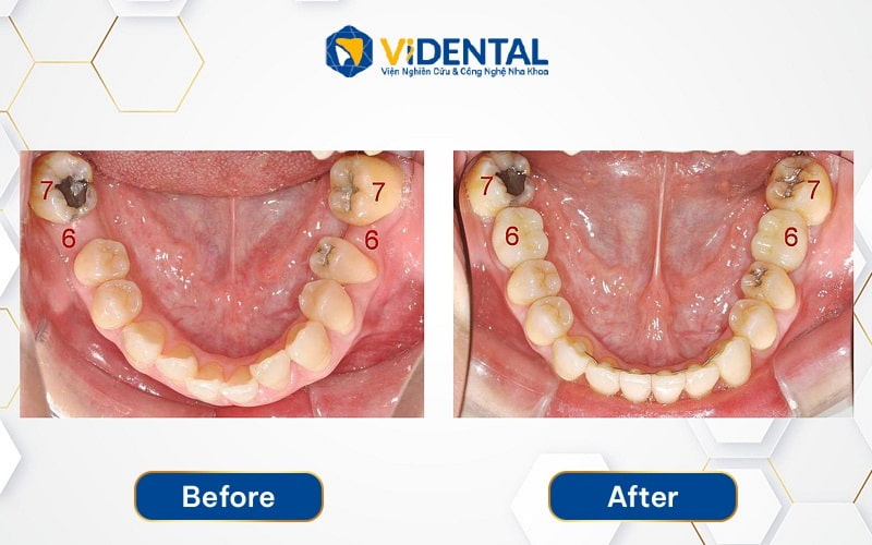 Hình ảnh răng hàm của khách hàng Nguyễn Ngọc Đông