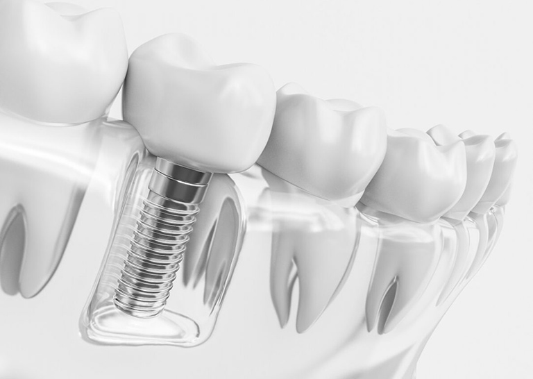 Địa chỉ trồng răng Implant uy tín ở Đà Lạt