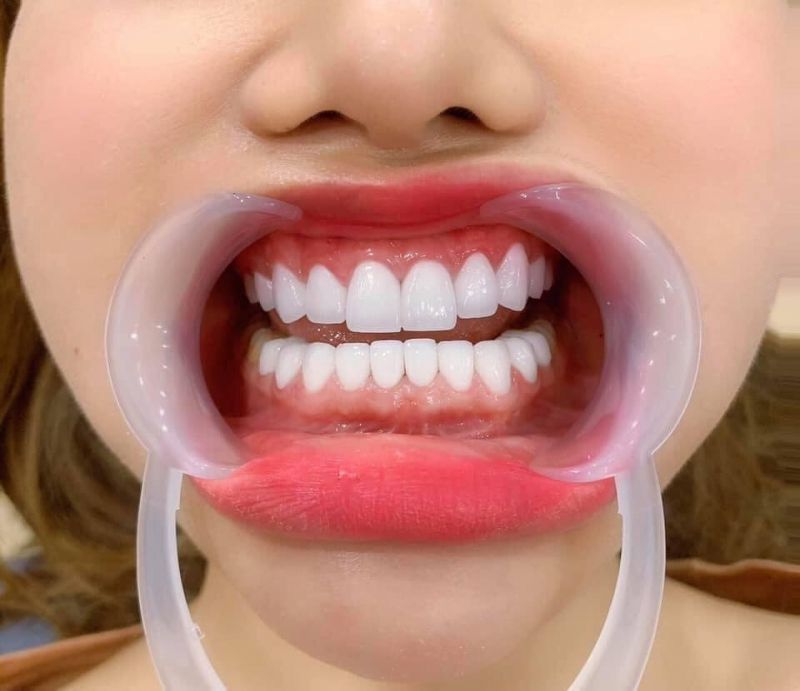Chi phí bọc răng do nhiều yếu tố tạo thành