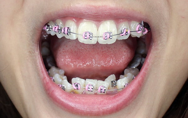Mắc cài đóng vai trò quan trọng trong quá trình niềng răng