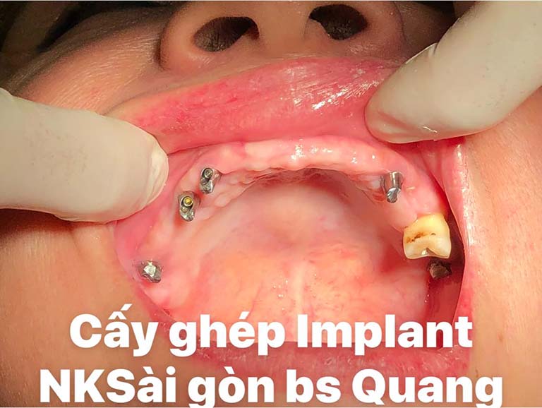 nha khoa trồng răng implant ở quận Tân Phú giá rẻ