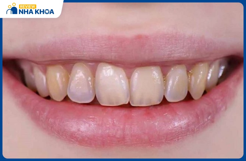 Men răng là một trong 4 mô lớn cấu tạo nên răng