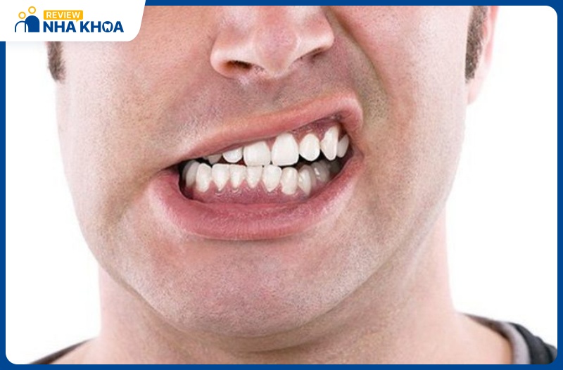 Thói quen nghiến răng sẽ khiến cho phần bảo vệ bên ngoài của răng bị suy yếu