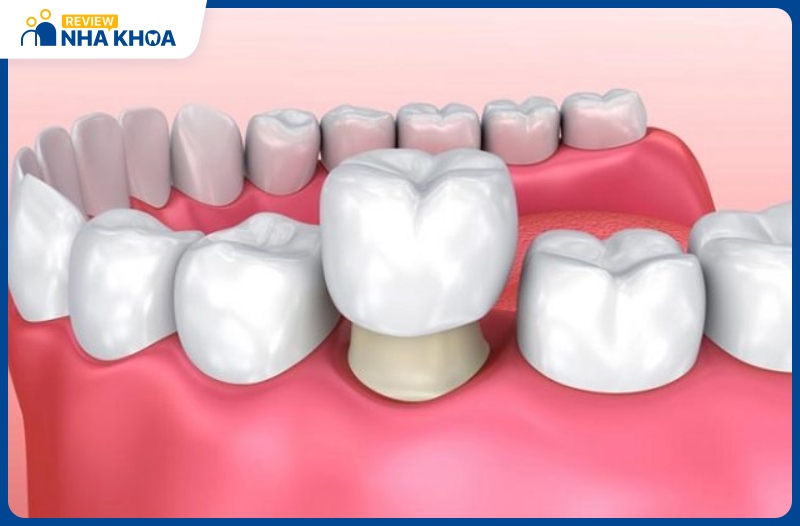 Bọc răng sứ mang lại hiệu quả cao trong điều trị răng nhạy cảm