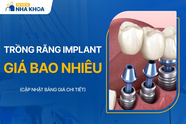 Bảng giá trồng răng Implant