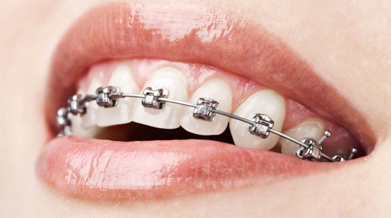 Niềng răng mắc cài là phương pháp chỉnh nha truyền thống