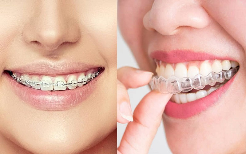 Niềng răng trong suốt và niềng răng mắc cài có nhiều điểm khác nhau
