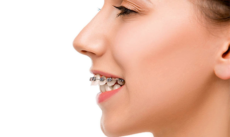 Thời gian trung bình cho các ca niềng răng hô dao động trong khoảng 18 – 24 tháng