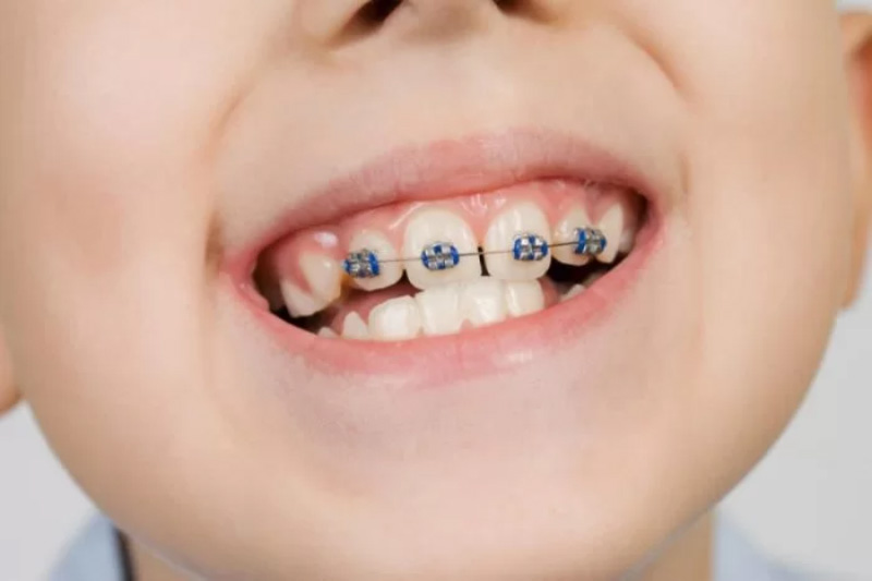Độ tuổi phù hợp nhất để niềng răng là 6 - 12 tuổi